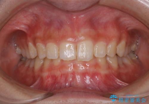 プラークを除去することによって歯の面のツヤ感が復活(PMTC30分コース)の症例 治療前