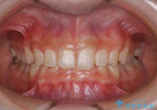 プラークを除去することによって歯の面のツヤ感が復活(PMTC30分コース)の治療後