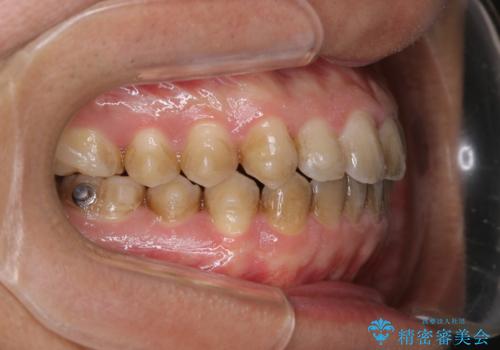 コーヒーを多く飲むインビザライン矯正中の患者様のクリーニングの治療前