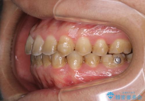 コーヒーを多く飲むインビザライン矯正中の患者様のクリーニングの治療前