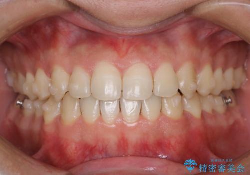 コーヒーを多く飲むインビザライン矯正中の患者様のクリーニングの症例 治療後