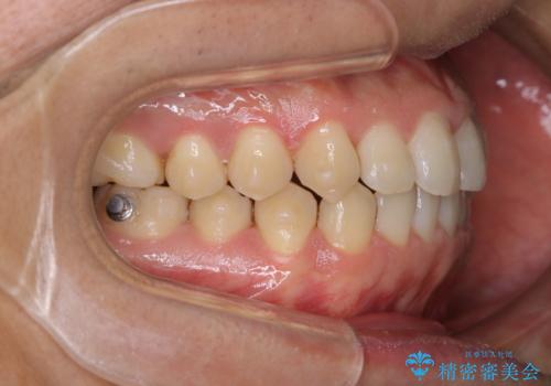 コーヒーを多く飲むインビザライン矯正中の患者様のクリーニングの治療後