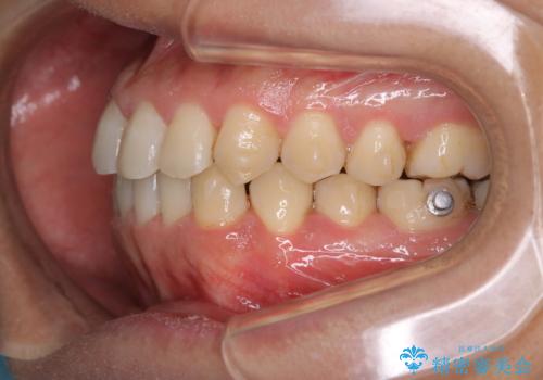 コーヒーを多く飲むインビザライン矯正中の患者様のクリーニングの治療後