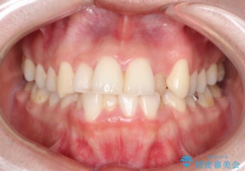 【ワイヤー矯正】前歯の凸凹を非抜歯で治療の症例 治療前