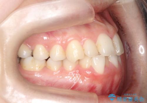 【ワイヤー矯正】前歯の凸凹を非抜歯で治療の治療前