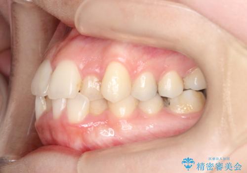 【ワイヤー矯正】前歯の凸凹を非抜歯で治療の治療前