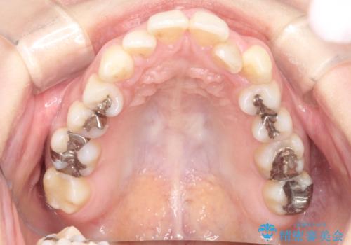 【ワイヤー矯正】前歯の凸凹を非抜歯で治療の治療前