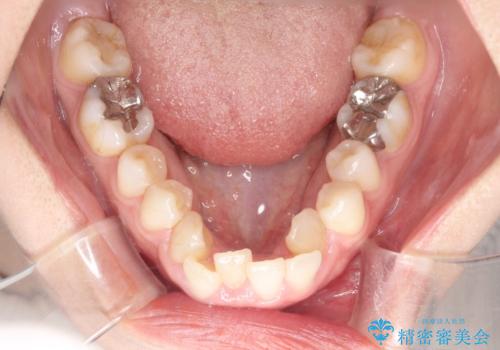 【ワイヤー矯正】前歯の凸凹を非抜歯で治療の治療前