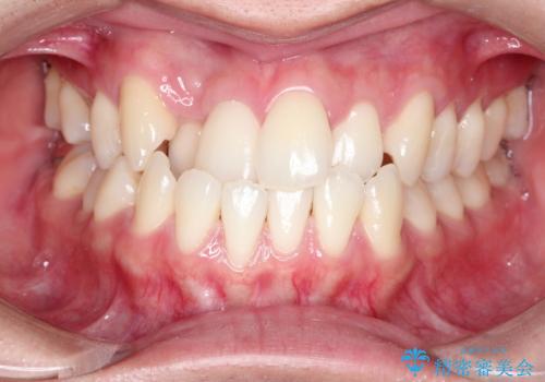 前歯が反対に咬んでいる　インビザラインによる矯正治療の症例 治療前
