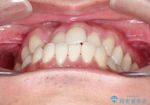 前歯が反対に咬んでいる インビザラインによる矯正治療の治療前