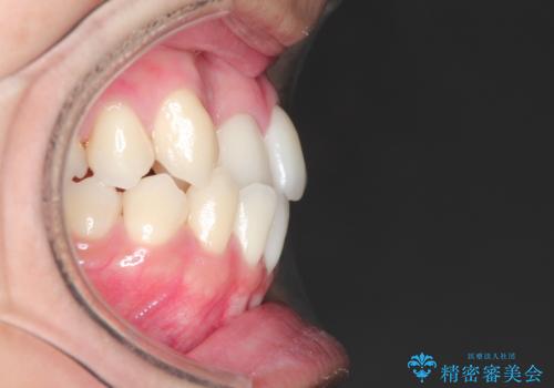 前歯が反対に咬んでいる　インビザラインによる矯正治療の治療前