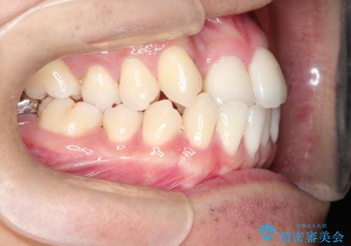 前歯が反対に咬んでいる インビザラインによる矯正治療の治療前