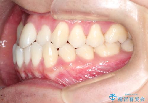 前歯が反対に咬んでいる インビザラインによる矯正治療の治療前
