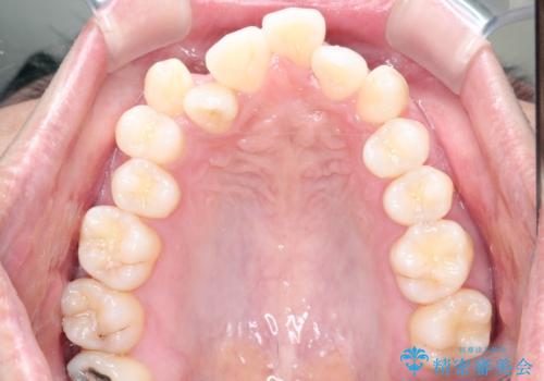 前歯が反対に咬んでいる インビザラインによる矯正治療の治療前