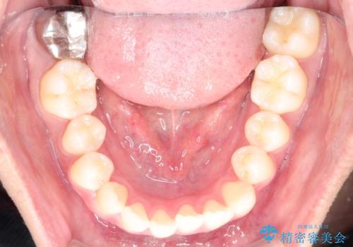 前歯が反対に咬んでいる　インビザラインによる矯正治療の治療前