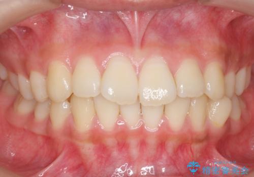 前歯のがたつき　部分矯正でコストダウンしながら、かみ合わせも治療の症例 治療前
