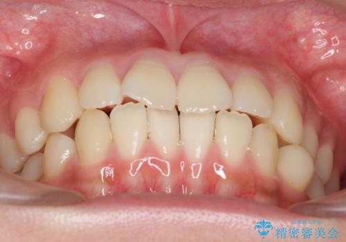 前歯のがたつき 部分矯正でコストダウンしながら、かみ合わせも治療の治療前