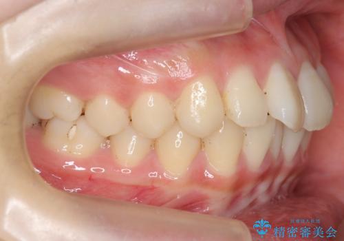 前歯のがたつき　部分矯正でコストダウンしながら、かみ合わせも治療の治療前