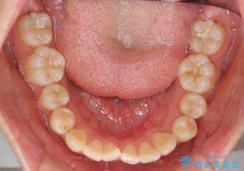 前歯のがたつき 部分矯正でコストダウンしながら、かみ合わせも治療の治療前