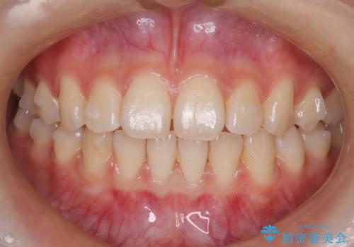 【前歯で噛めません、すきっ歯も気になります】インビザライン治療症例の治療中