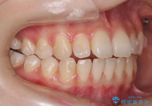 【前歯で噛めません、すきっ歯も気になります】インビザライン治療症例の治療中