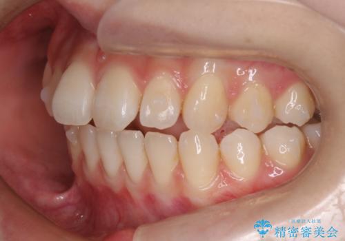 【前歯で噛めません、すきっ歯も気になります】インビザライン治療症例の治療中