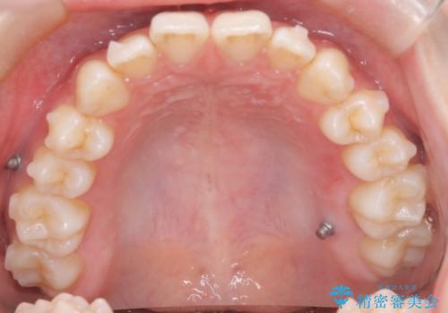【前歯で噛めません、すきっ歯も気になります】インビザライン治療症例の治療中