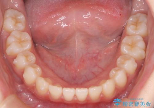 【前歯で噛めません、すきっ歯も気になります】インビザライン治療症例の治療中