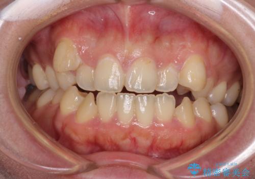 八重歯を抜歯矯正でスッキリと　メタルブラケットでの矯正治療の症例 治療前