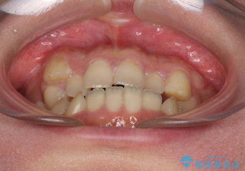 八重歯を抜歯矯正でスッキリと メタルブラケットでの矯正治療の治療前