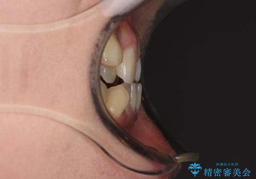 八重歯を抜歯矯正でスッキリと メタルブラケットでの矯正治療の治療前