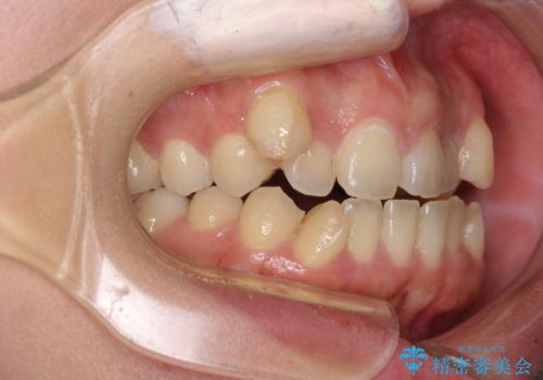 八重歯を抜歯矯正でスッキリと　メタルブラケットでの矯正治療の治療前