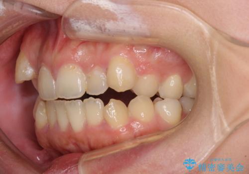 八重歯を抜歯矯正でスッキリと メタルブラケットでの矯正治療の治療前