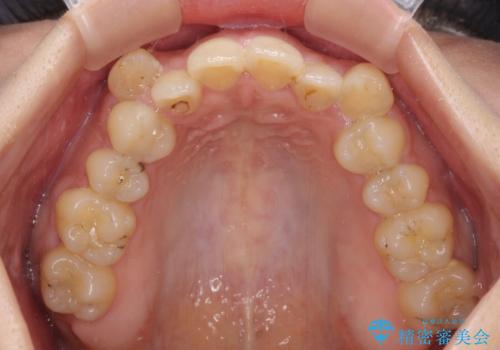 八重歯を抜歯矯正でスッキリと メタルブラケットでの矯正治療の治療前