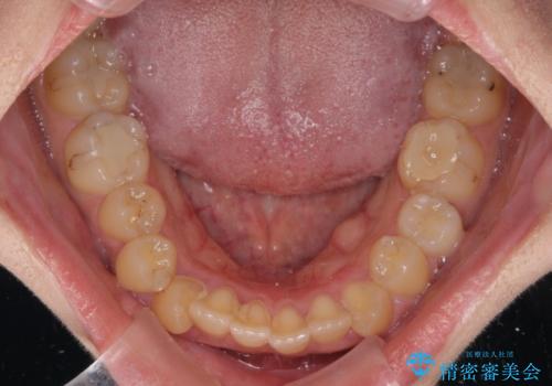 八重歯を抜歯矯正でスッキリと メタルブラケットでの矯正治療の治療前