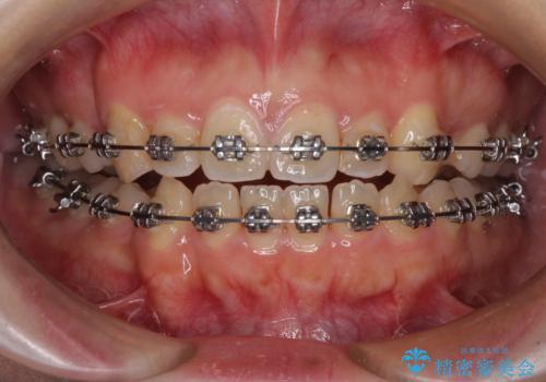 八重歯を抜歯矯正でスッキリと メタルブラケットでの矯正治療の治療中