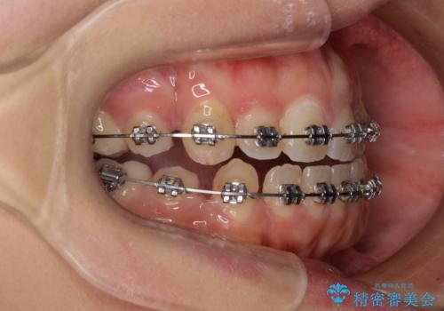 八重歯を抜歯矯正でスッキリと　メタルブラケットでの矯正治療の治療中