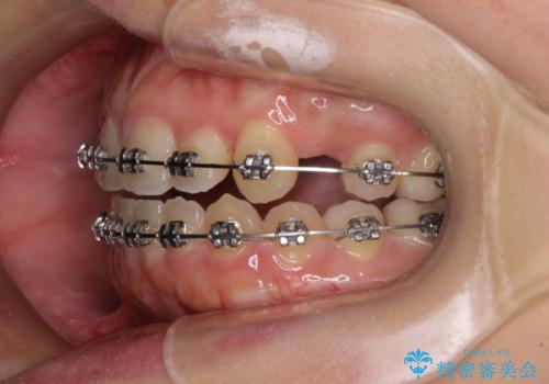 八重歯を抜歯矯正でスッキリと　メタルブラケットでの矯正治療の治療中