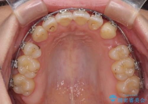 八重歯を抜歯矯正でスッキリと メタルブラケットでの矯正治療の治療中