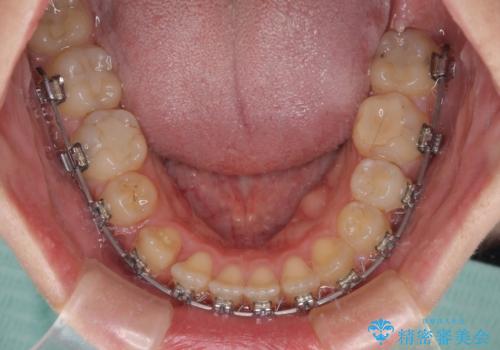 八重歯を抜歯矯正でスッキリと メタルブラケットでの矯正治療の治療中