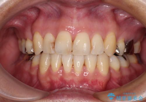 八重歯で口元が膨れている　ワイヤー装置での抜歯矯正の症例 治療後