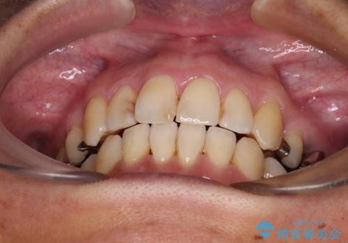八重歯で口元が膨れている　ワイヤー装置での抜歯矯正の治療後