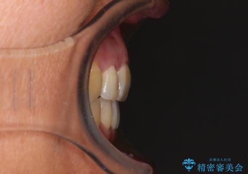 八重歯で口元が膨れている ワイヤー装置での抜歯矯正の治療後