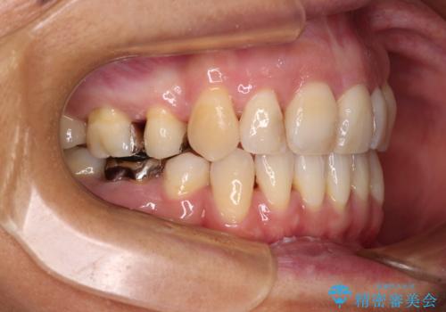 八重歯で口元が膨れている ワイヤー装置での抜歯矯正の治療後