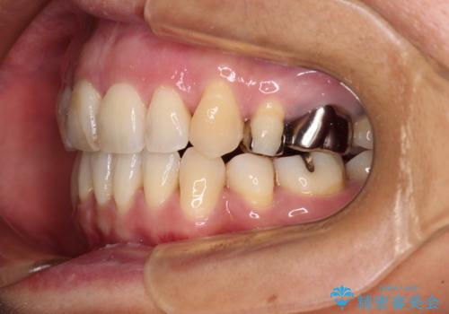 八重歯で口元が膨れている ワイヤー装置での抜歯矯正の治療後