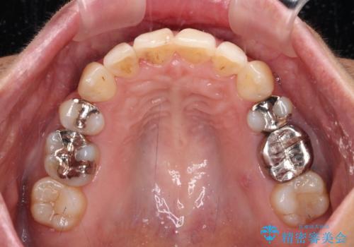 八重歯で口元が膨れている ワイヤー装置での抜歯矯正の治療後