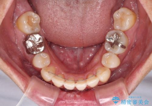 八重歯で口元が膨れている ワイヤー装置での抜歯矯正の治療後