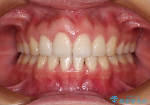 前歯の出っ歯と口の閉じにくさが気になる　目立たないワイヤー装置での抜歯矯正の症例 治療後