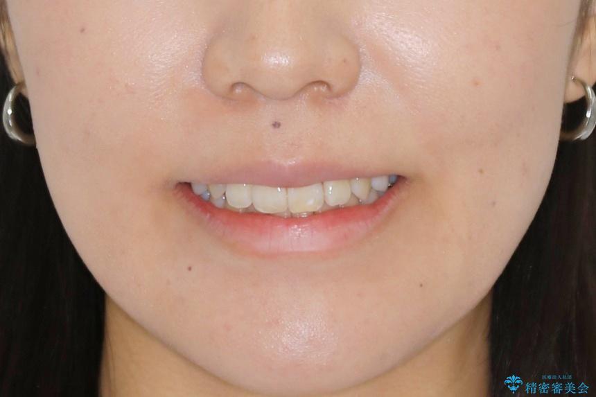 【非抜歯】インビザライン　隠れた前歯を並べる矯正治療の治療後（顔貌）