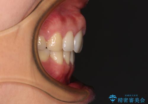 前歯の出っ歯と口の閉じにくさが気になる 目立たないワイヤー装置での抜歯矯正の治療後